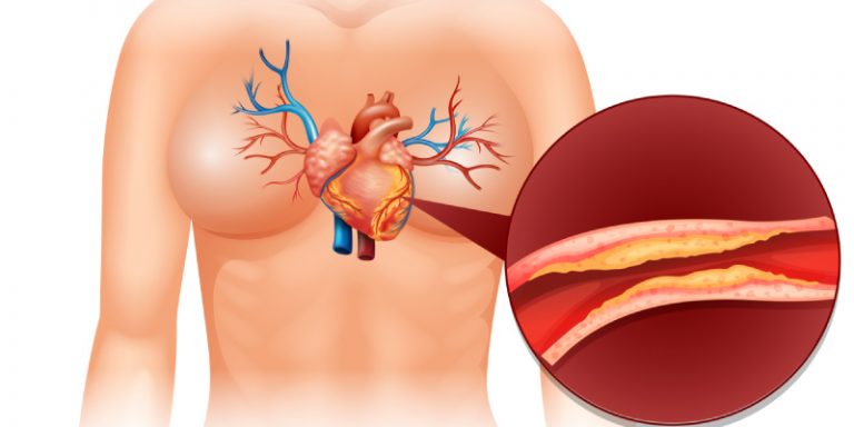 چربی خون از دیدگاه طب سنتی